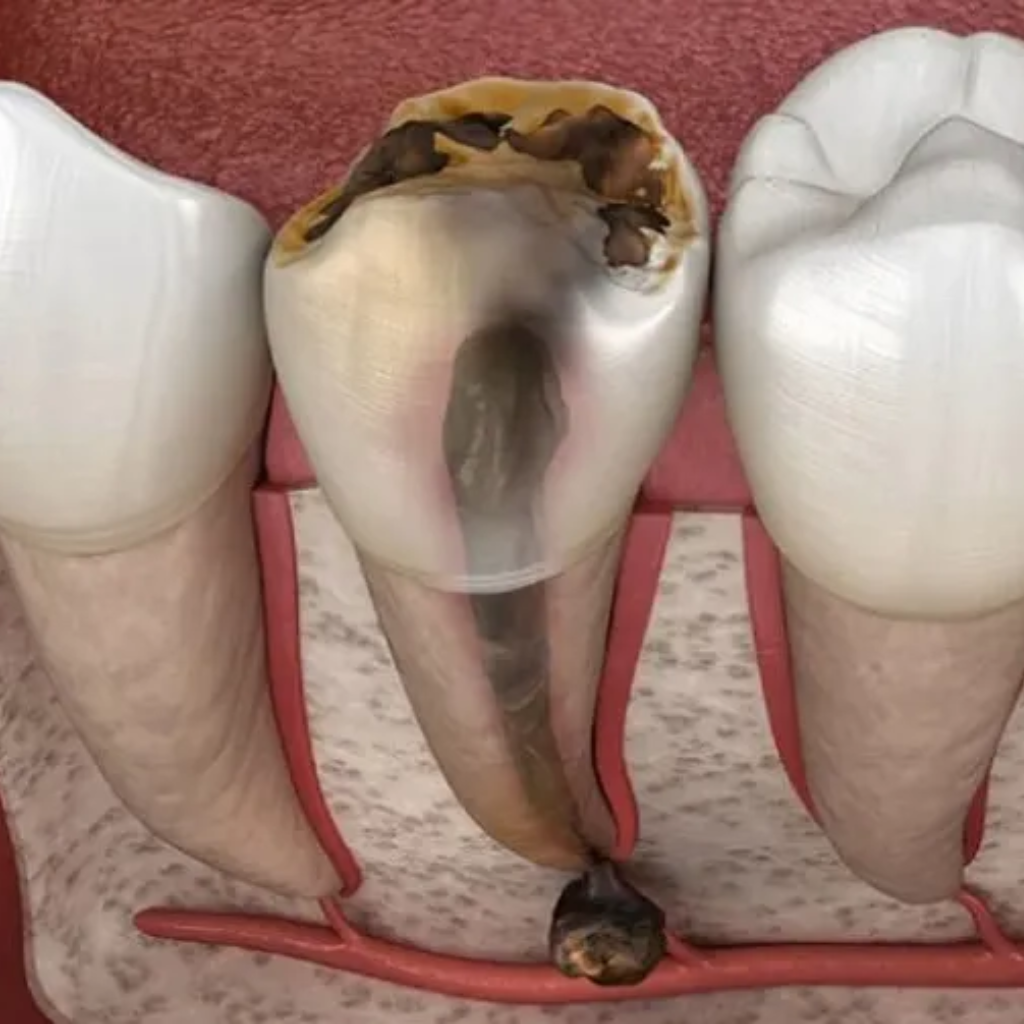 Viêm tủy răng là tình trạng viêm mô tuỷ răng do sâu răng gây ra