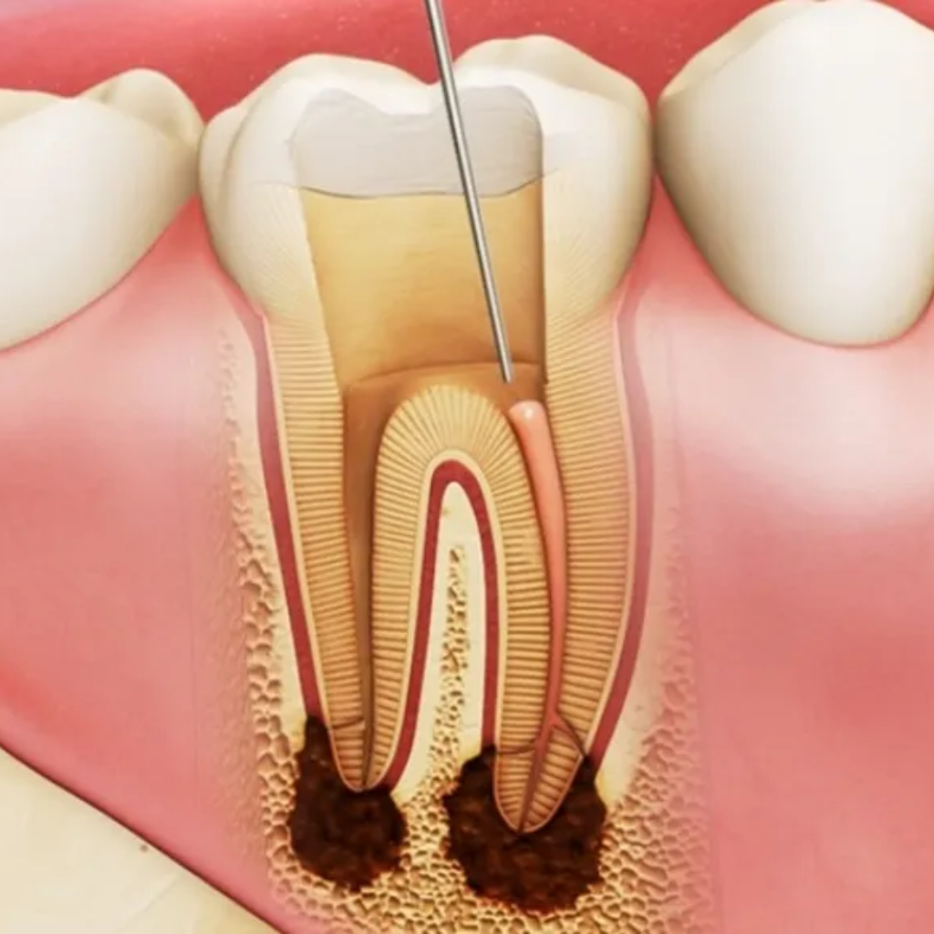 Một số nguyên nhân chính gây ra bệnh viêm tủy răng