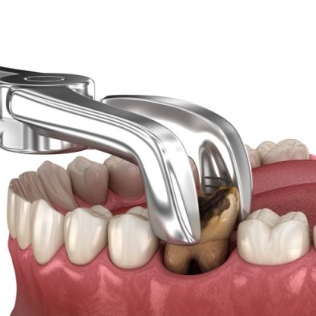 Viêm tuỷ răng không thể tự khỏi