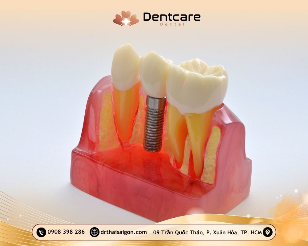 trồng răng implant quận 3