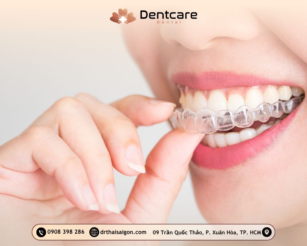 niềng răng trong suốt