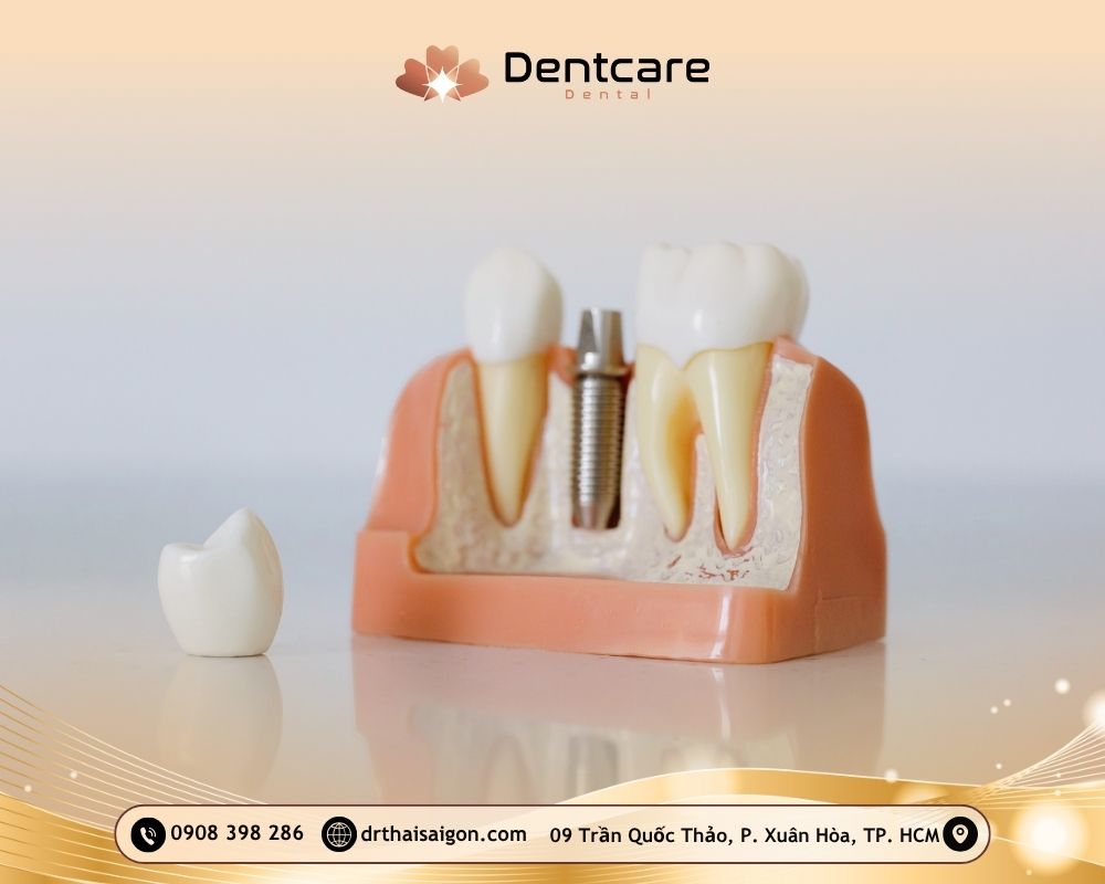 trồng răng implant cho người lớn tuổi