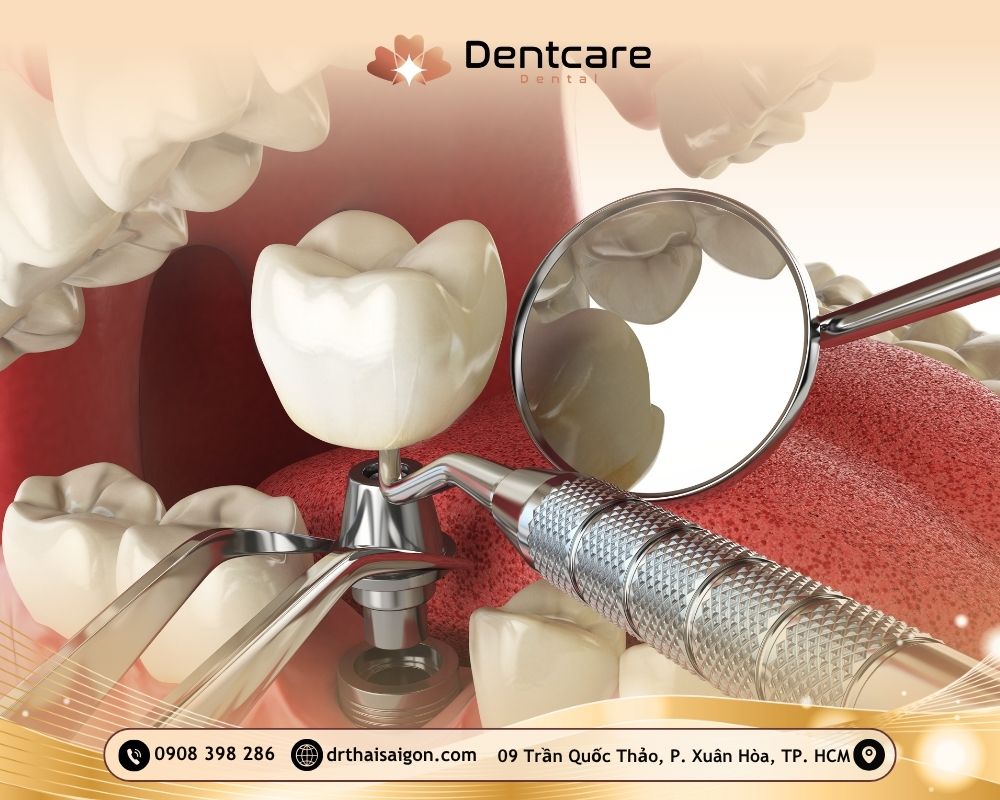 trồng răng implant mất bao lâu