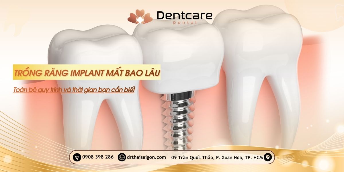 trồng răng implant mất bao lâu