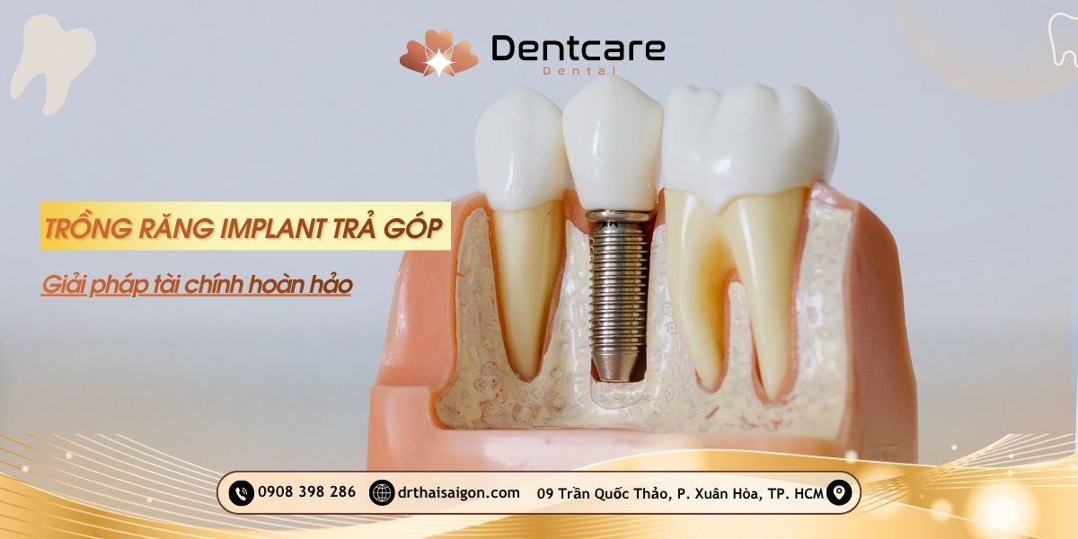 trồng răng implant trả góp