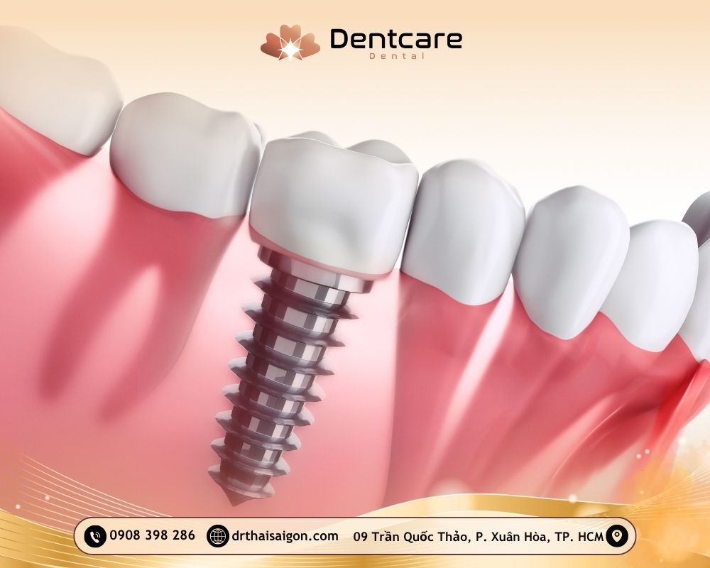 trồng răng implant trả góp