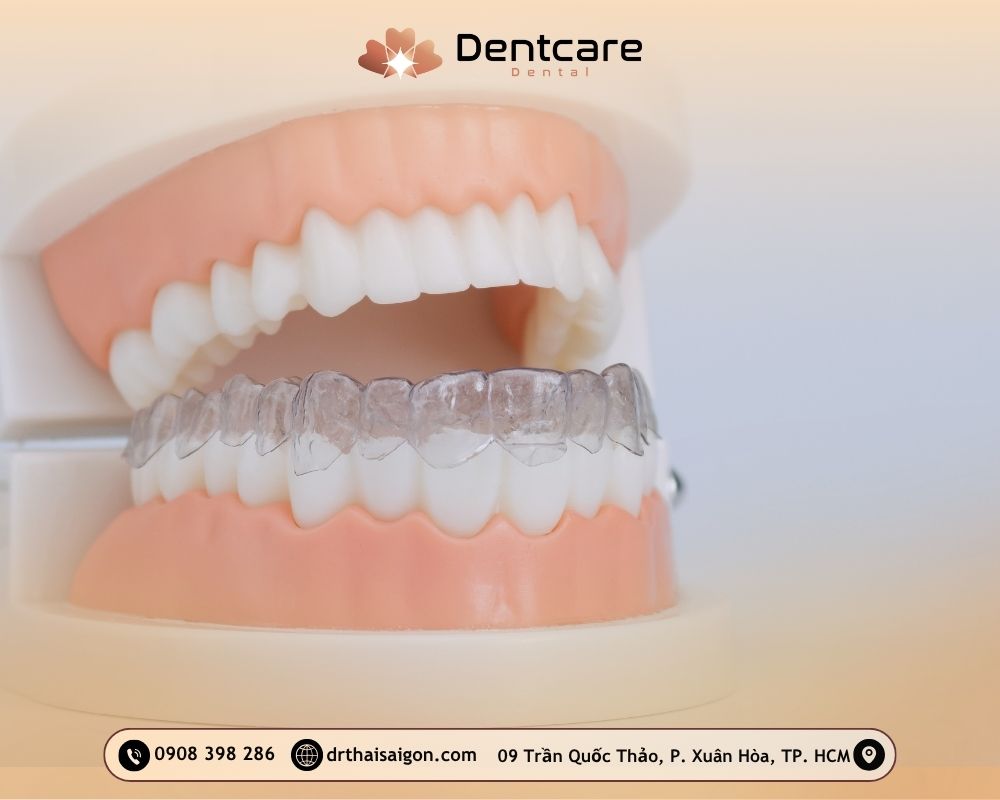 niềng răng trong suốt