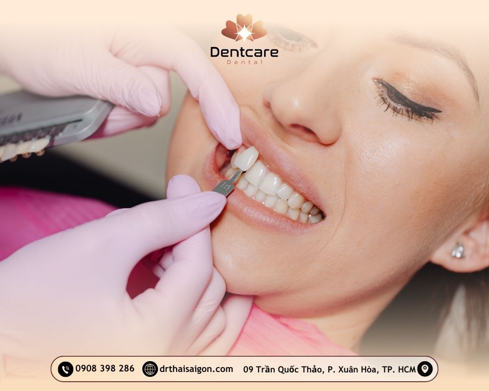 dán sứ veneer giá bao nhiêu