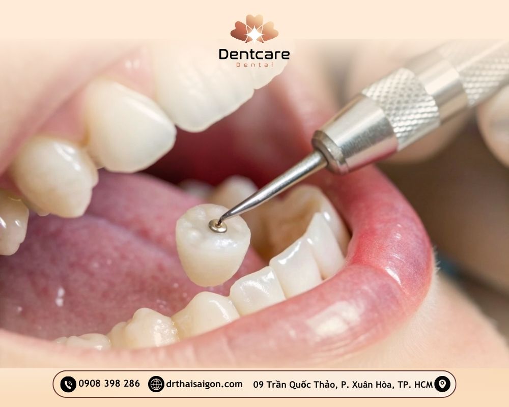 bọc răng sứ giá bao nhiêu