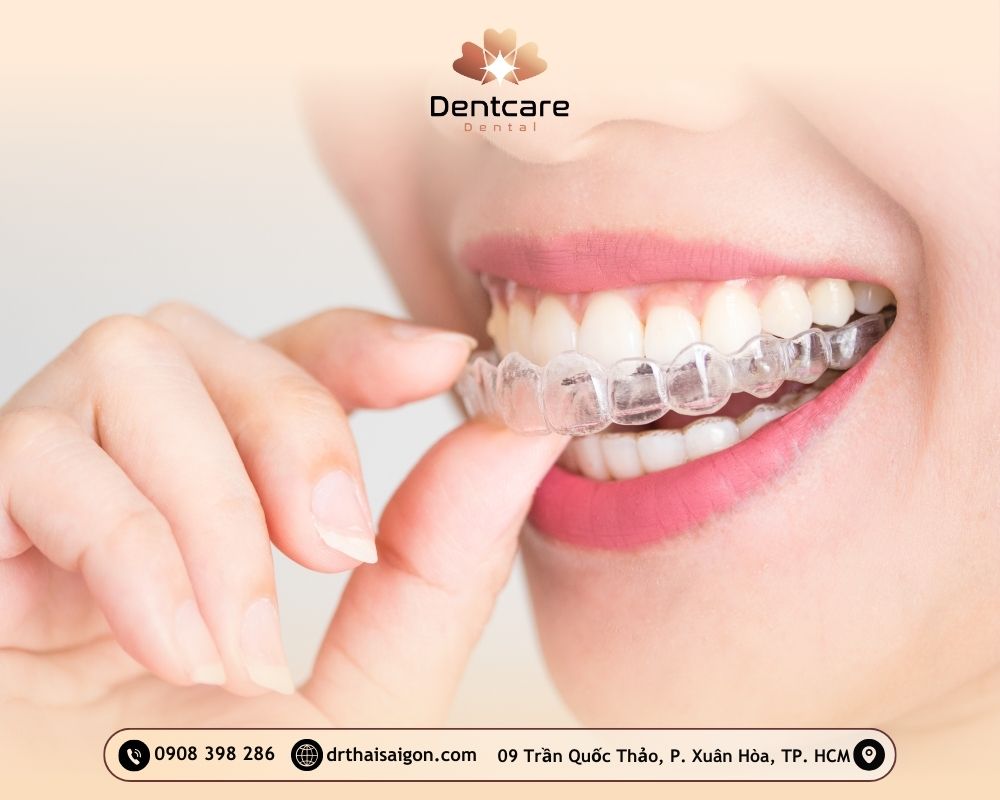 niềng răng giá bao nhiêu