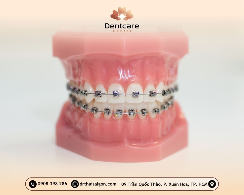 niềng răng giá bao nhiêu