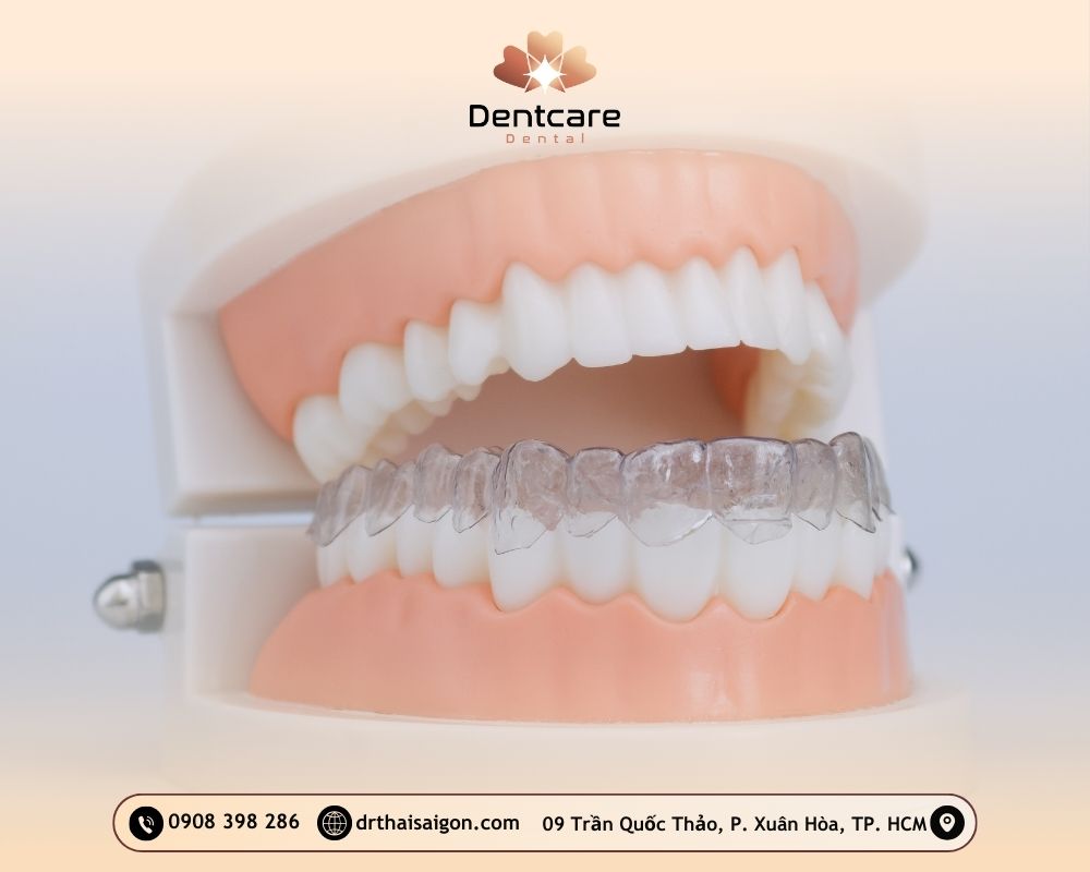 niềng răng giá bao nhiêu